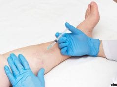 Cómo quitar las varices de las piernas