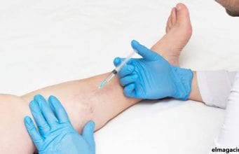 Cómo quitar las varices en las piernas en casos severos de venas varicosas Cómo quitar las varices de las piernas