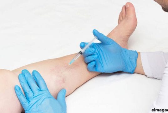 Cómo quitar las varices de las piernas