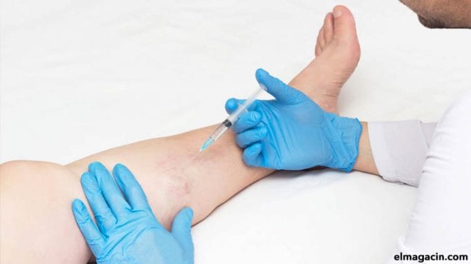 Cómo quitar las varices de las piernas Cómo quitar las varices de las piernas