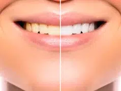 Cómo blanquear los dientes y devolverles un color natural