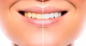 Cómo blanquear los dientes y devolverles un color natural