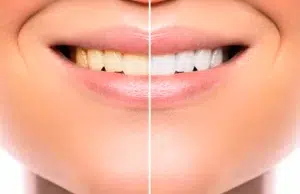 Cómo blanquear los dientes y devolverles un color natural Cómo blanquear los dientes y devolverles un color natural