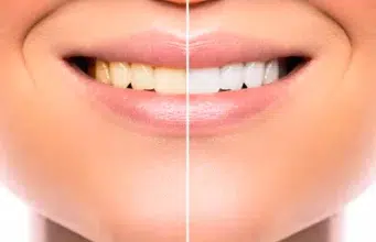 Cómo blanquear los dientes y devolverles un color natural Cómo blanquear los dientes y devolverles un color natural