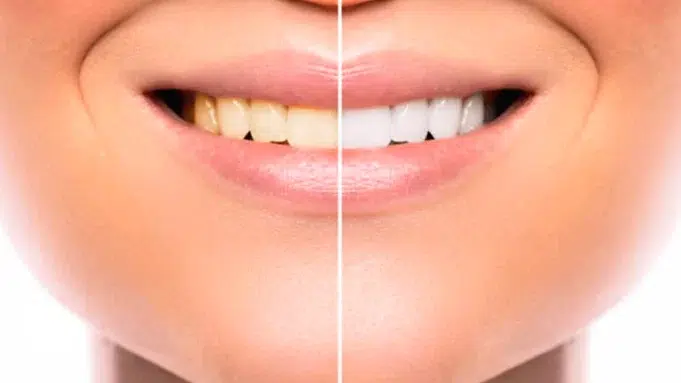 Cómo blanquear los dientes y devolverles un color natural Cómo blanquear los dientes y devolverles un color natural