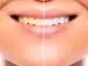 Cómo blanquear los dientes y devolverles un color natural Cómo blanquear los dientes y devolverles un color natural